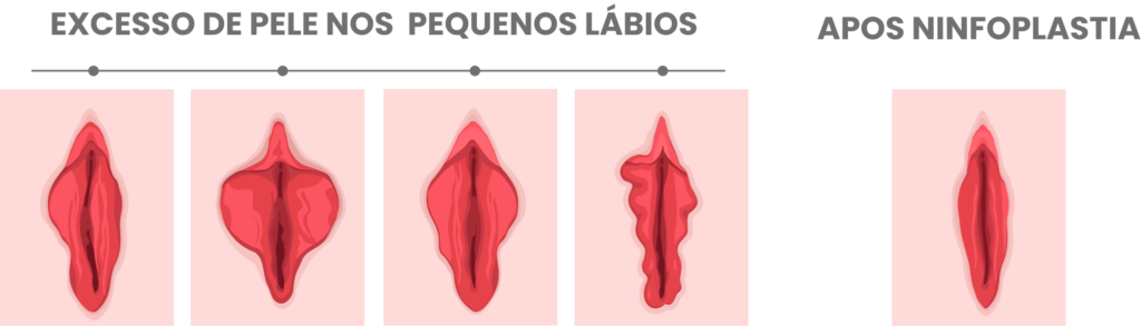 Ninfoplastia a Laser Doi Antes e Depois Ninfoplastia